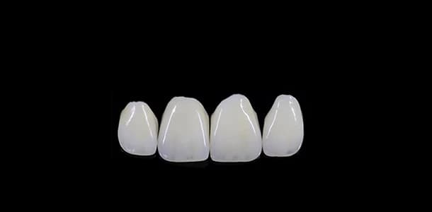 e.max® (Lithium-Disilikat)